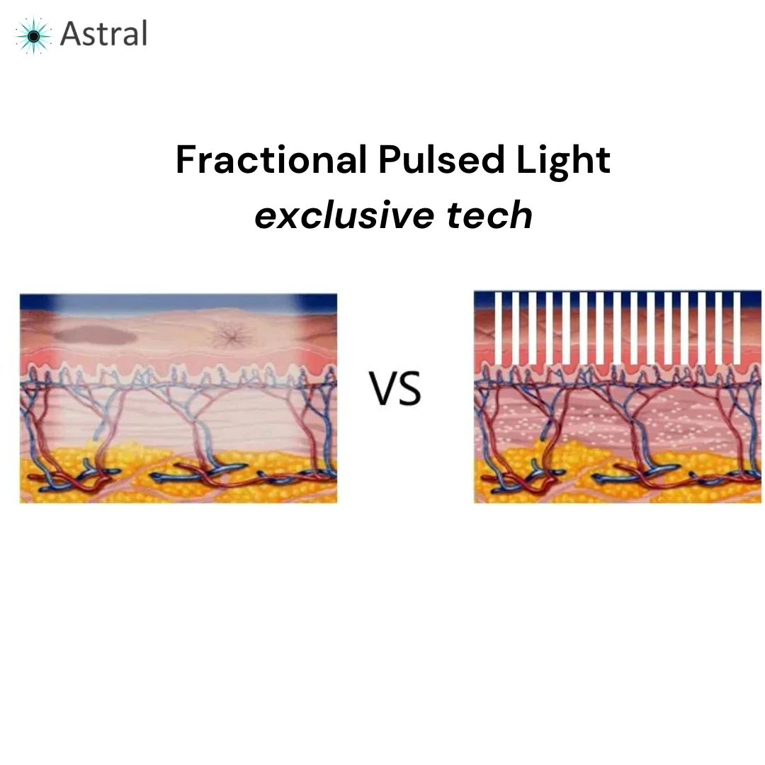 APEX™ 10D Professional Intense Pulsed Light System - Image 8