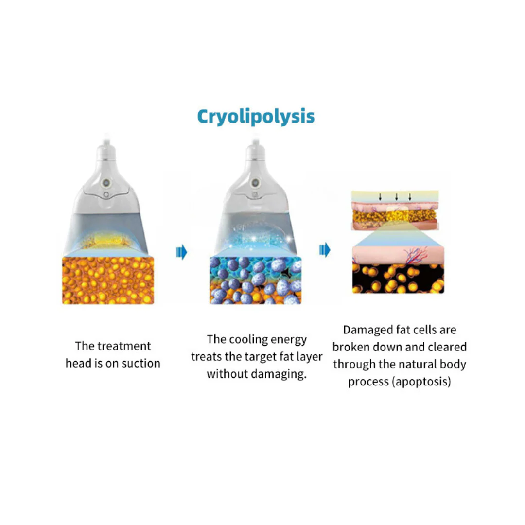 Diamond Ice Cryo EMShape® Mini - Image 8