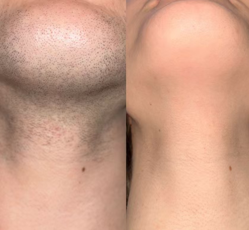 DuoSmooth™ 2-in-1 Diode Laser + IPL System - Image 11