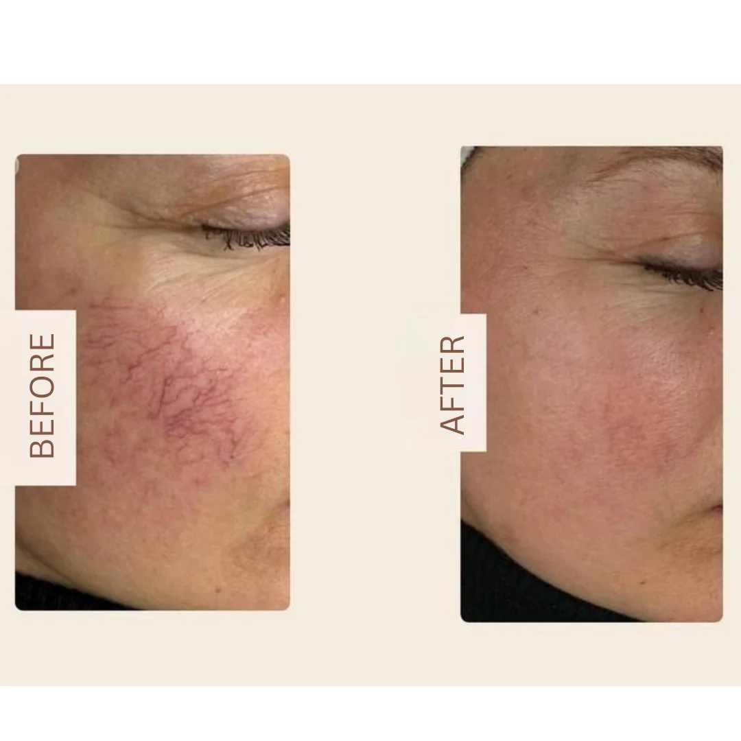 DuoSmooth™ 2-in-1 Diode Laser + IPL System - Image 12