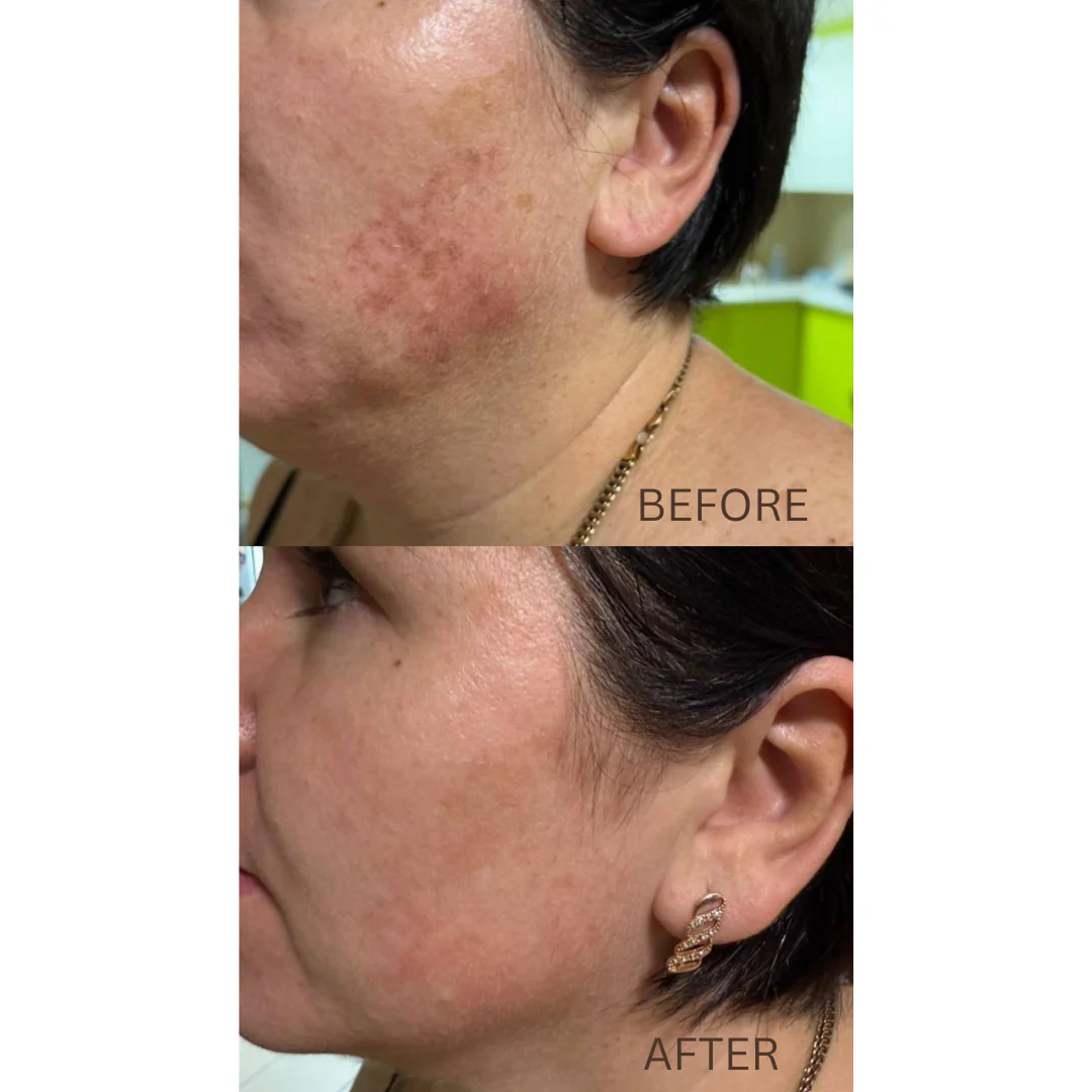 DuoSmooth™ 2-in-1 Diode Laser + IPL System - Image 13