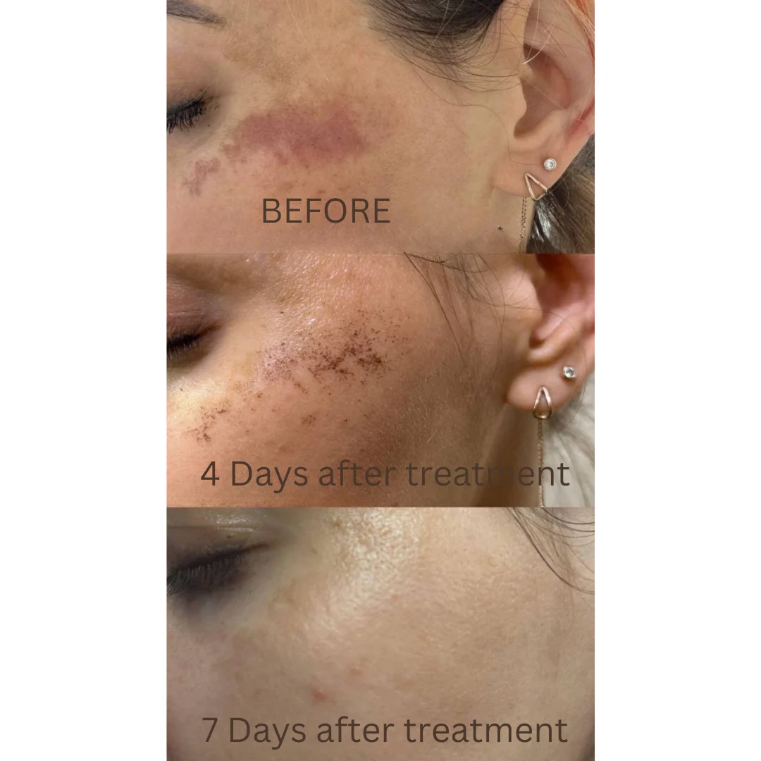 DuoSmooth™ 2-in-1 Diode Laser + IPL System - Image 15