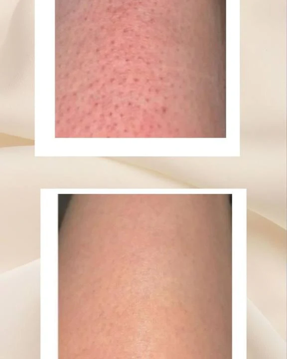 DuoSmooth™ 2-in-1 Diode Laser + IPL System - Image 14