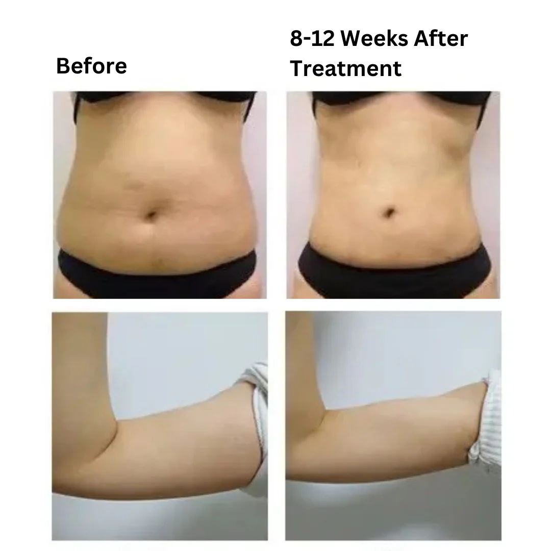 LipoSonic Portable Weight Loss HIFU Machine - Image 3