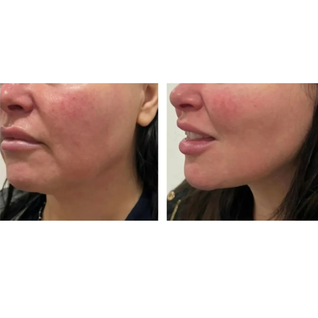PERFECT FACE NEO 6D Complete - Image 17