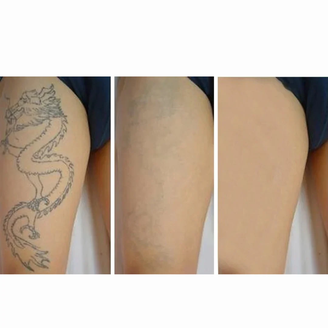 PicoElim™ Pico Laser Tattoo Removal Machine - Image 3