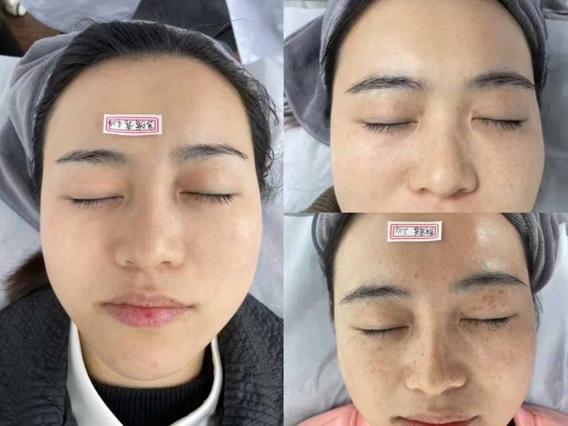 PicoPretty® Picosecond Laser - 4D Complete Pigment Solution - Image 11