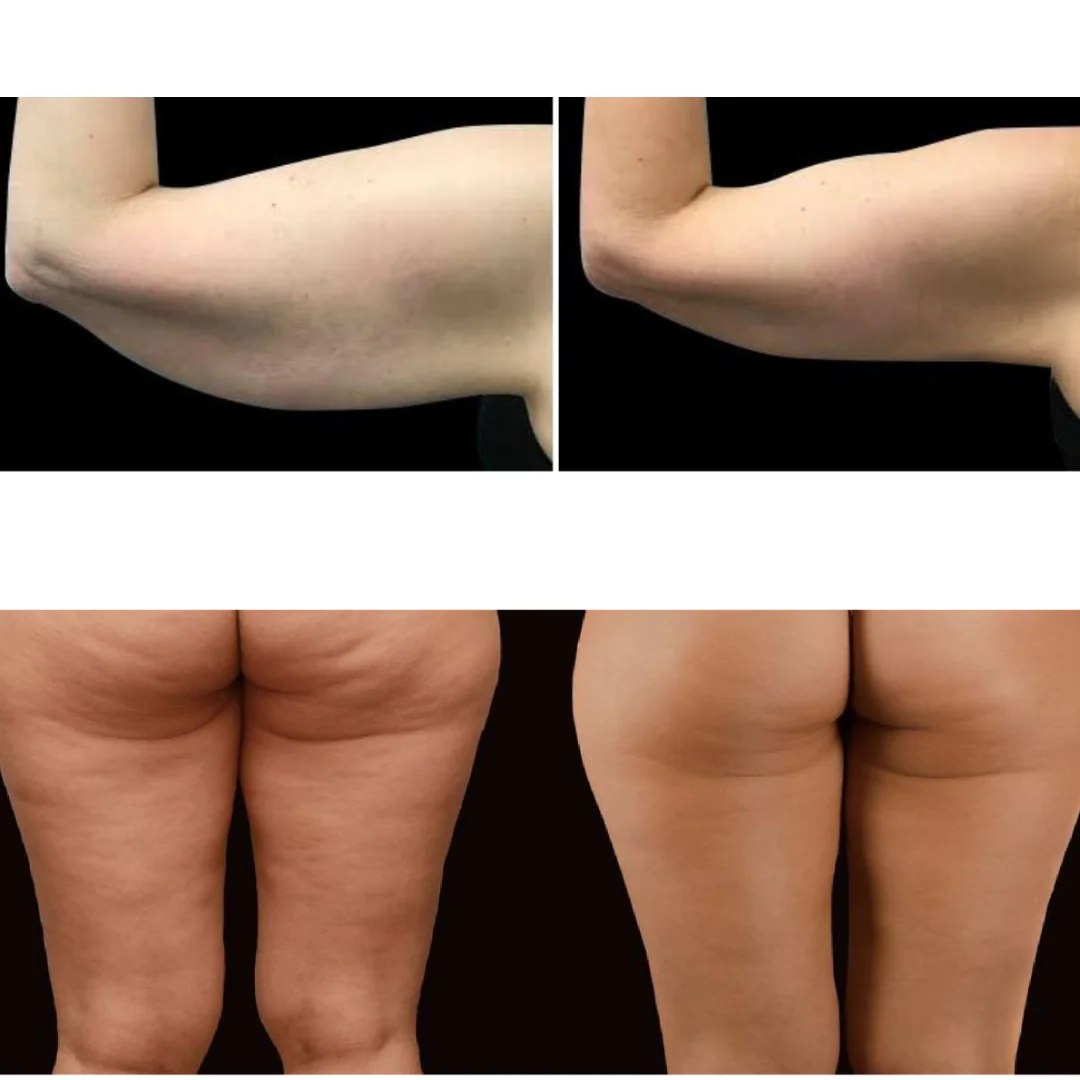 Adonis™ 30K Cavitation Machine Pro 9 in 1 - Image 14