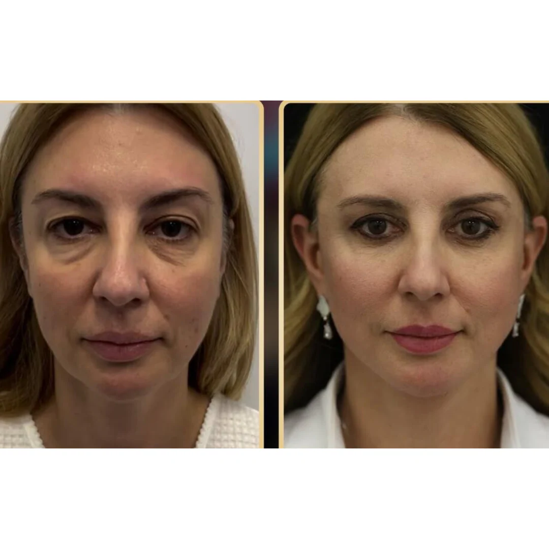 Professional PERFECT SHAPE® NEO PLUS (Body & Face) - Image 10