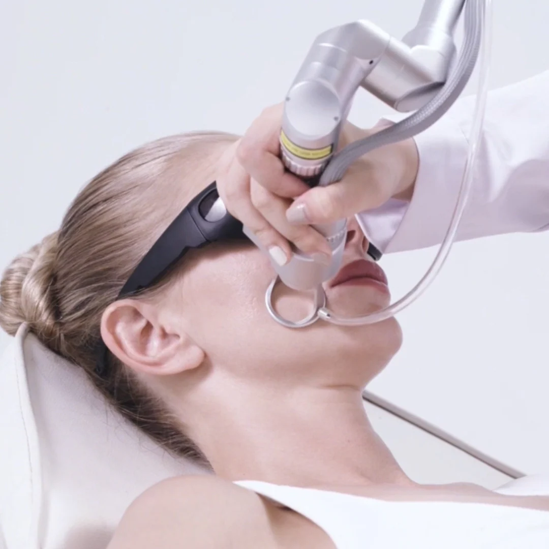 CarbonFrax™  Pro CO2 Fractional Laser - Image 5