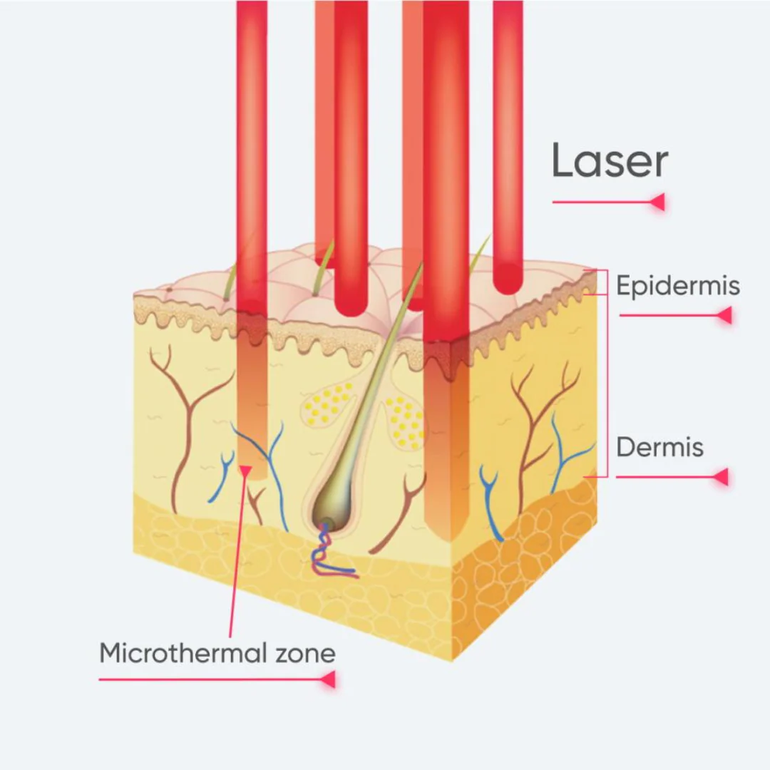 CarbonFrax™  Pro CO2 Fractional Laser - Image 4
