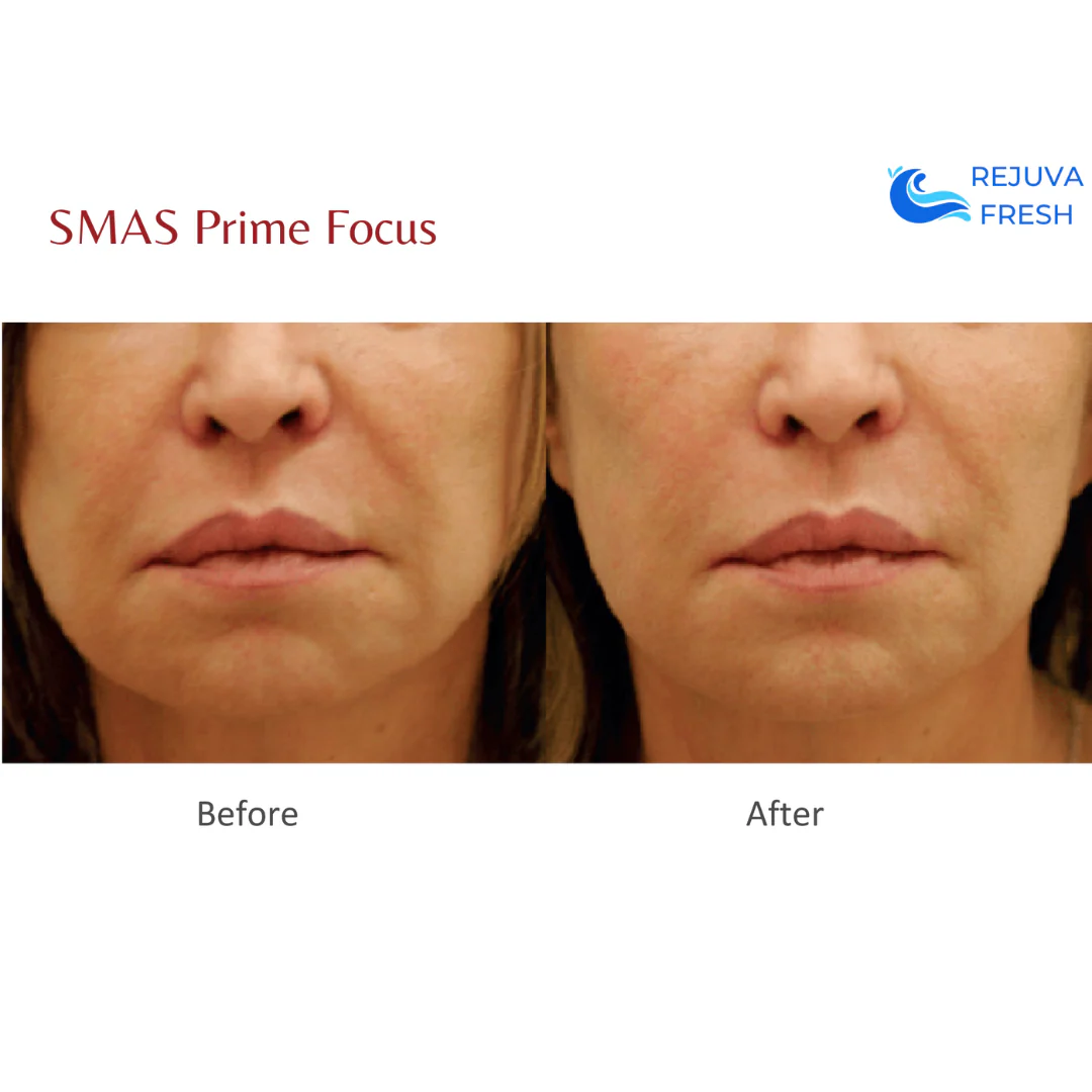 SMAS Prime Focus Professional HIFU Machine for Body & Face - Image 3