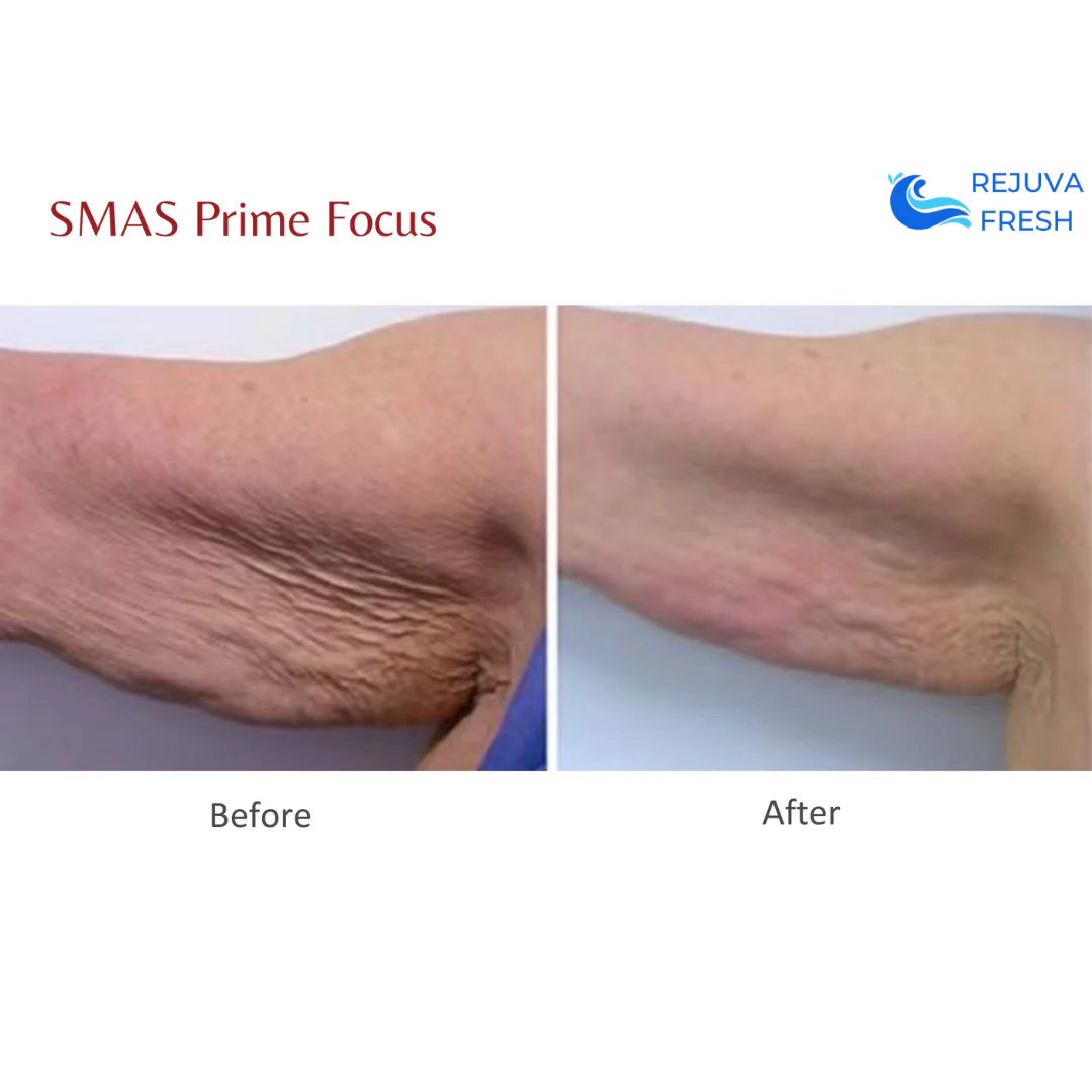 SMAS Prime Focus Professional HIFU Machine for Body & Face - Image 5